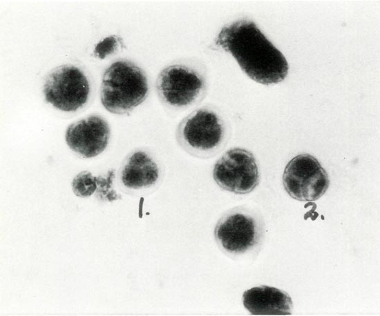 Photomicrograph of Stage V